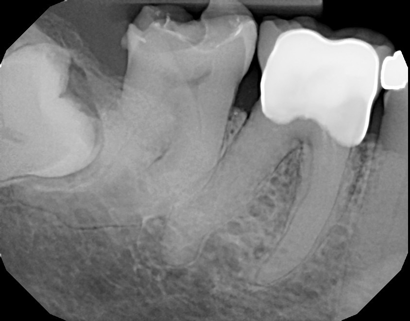 Tooth #31 with a very curved and calcified root canal system with limited access. 